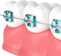 Металлическая самолиг. брекет-система ORMCO (1 зубной ряд)