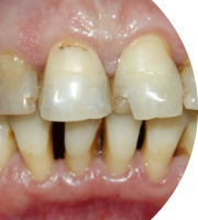 Улучшение формы зубного ряда