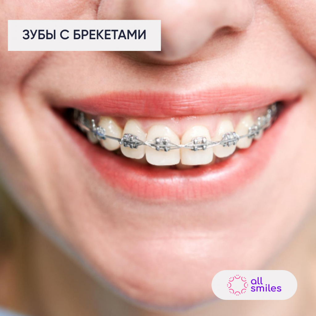 Зубы с брекетами.jpg