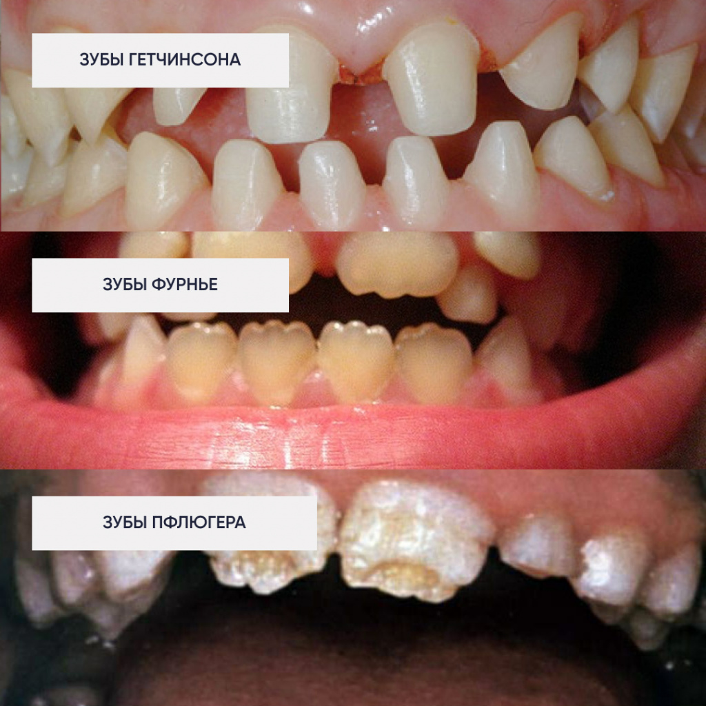 Формы гипоплазии эмали зубов