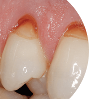 Устранения дефектов зуба