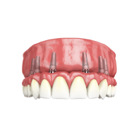 Несъемный адаптационный армированный зубной протез