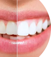 Осветлённые зубы на 2-3 тона