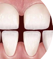 Неровный зубной ряд, диастемы