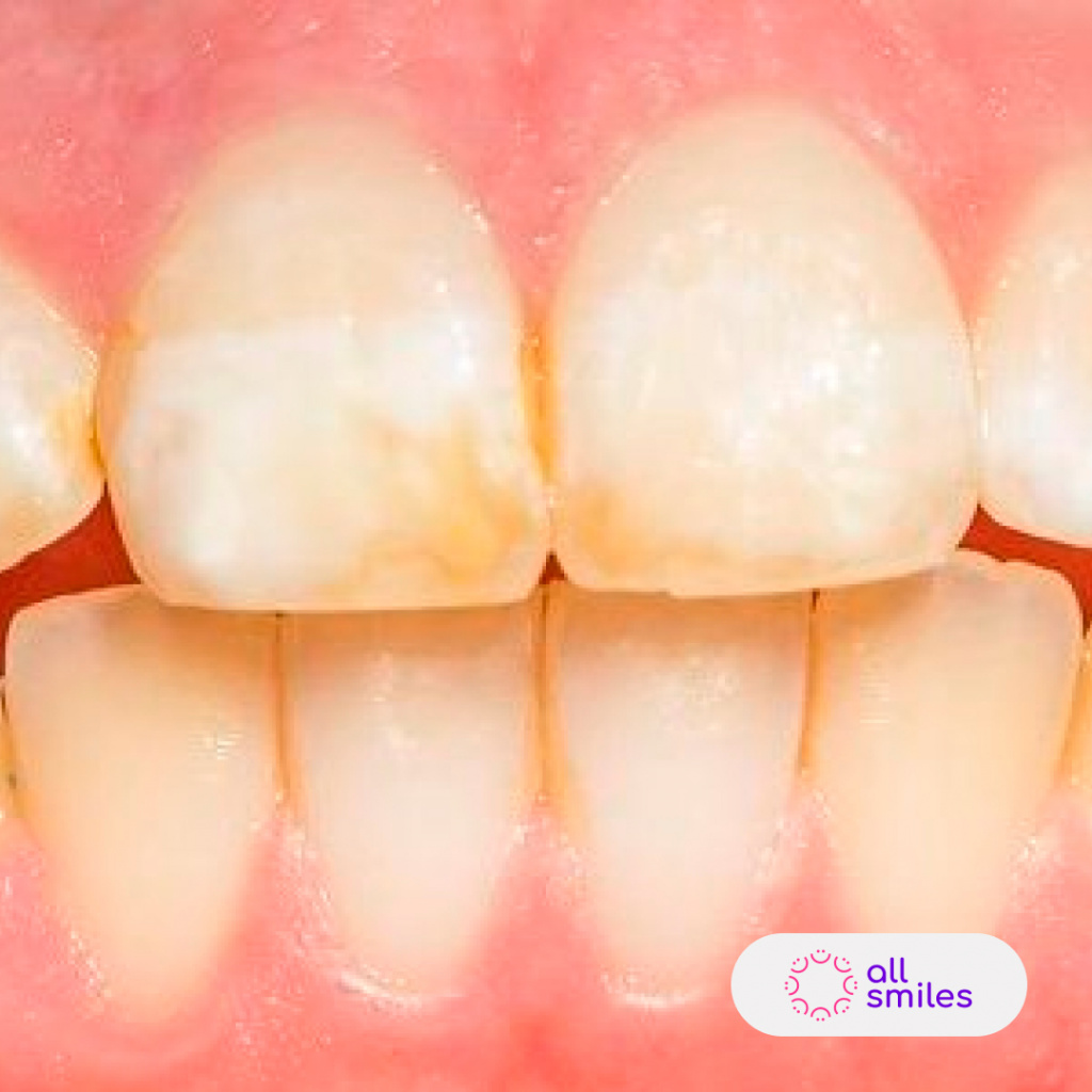 Патология твердых тканей. Гипоплазия зубной эмали. Некариозные поражения эмали. Некариозное поражение зубов. Клиновидный дефект зубов.