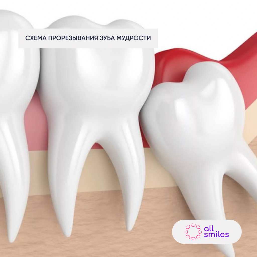 Схема прорезывания зуба мудрости.jpg