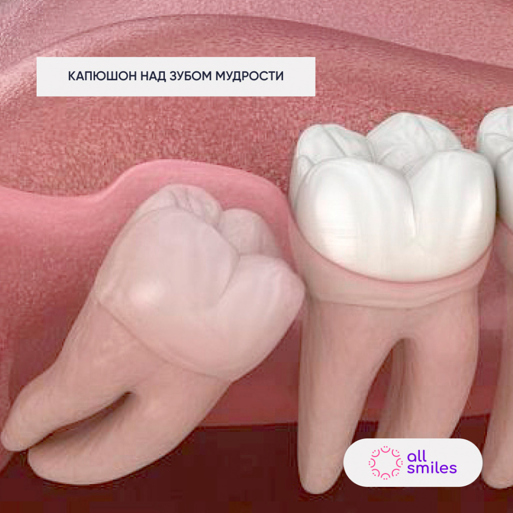 Капюшон над зубом мудрости.