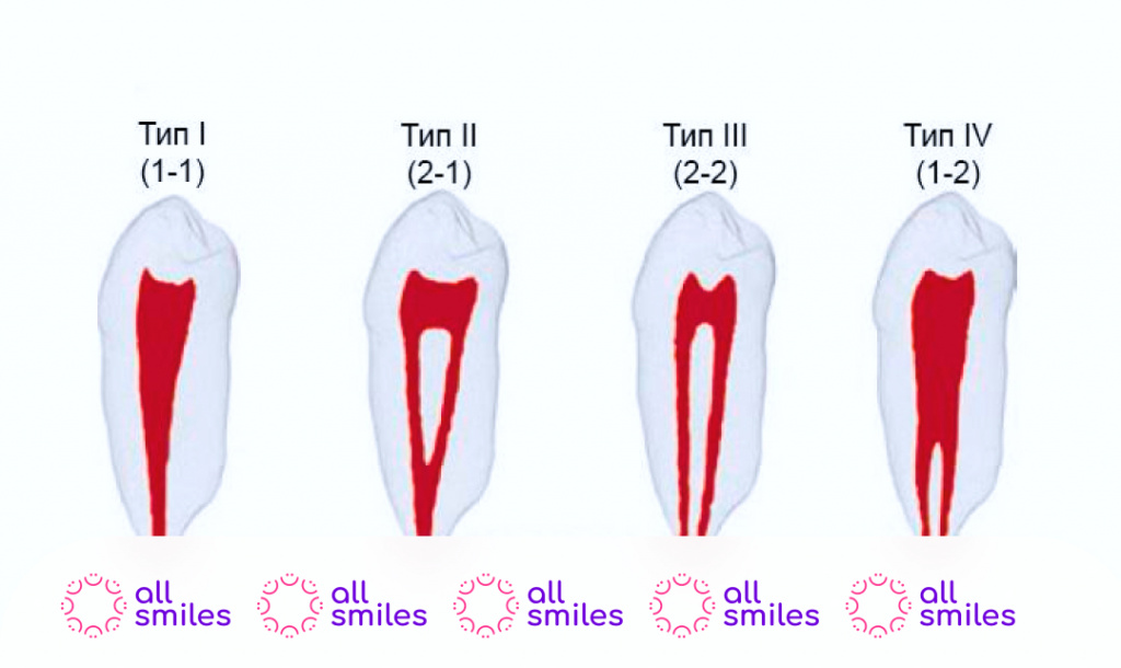 Какие бывают каналы в зубе