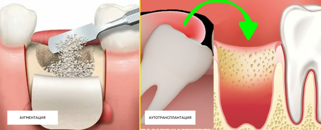 Аугментация и аутотрансплантация