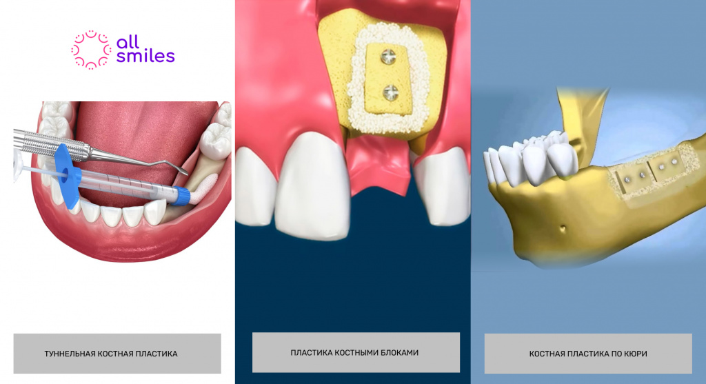 Виды костной пластики стоматология