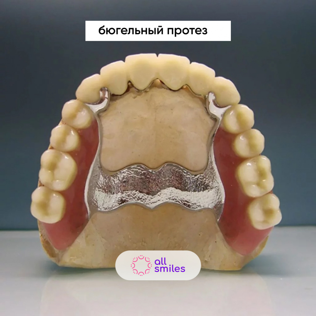 Зубной бюгельный протез