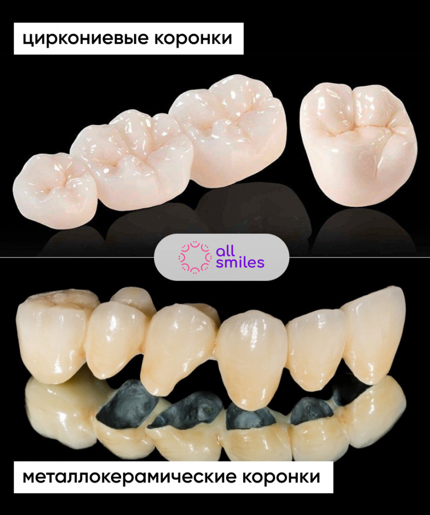 Циркониевые и металлокерамические зубные коронки в чем разница
