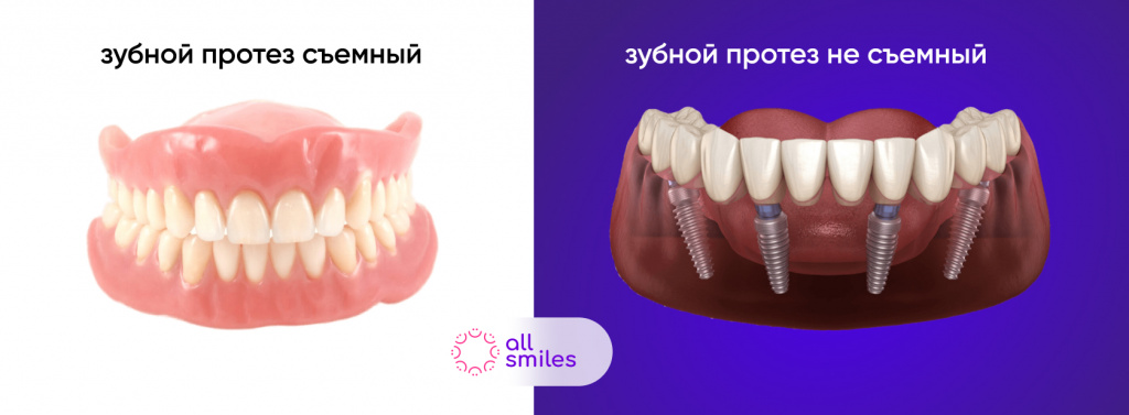 Как выглядит съемный и несъемный зубные протезы