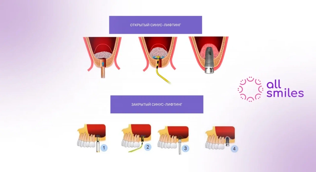 Открытый и закрытый синус лифтинг разница