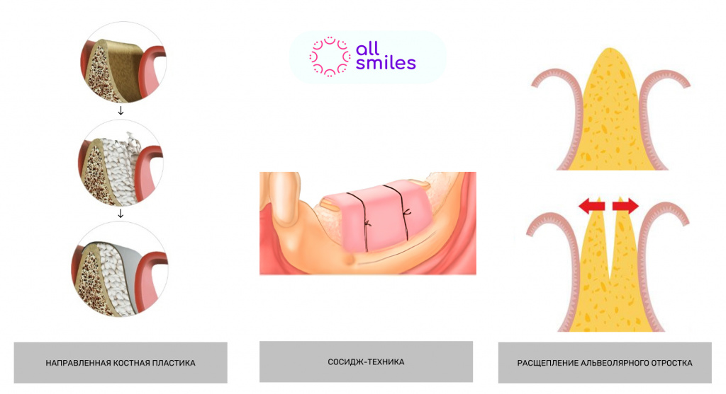 Техника костной пластики челюсти