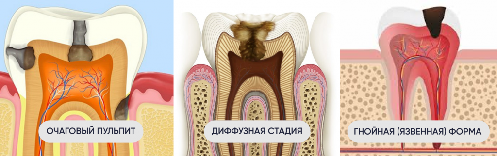 Виды острого пульпита