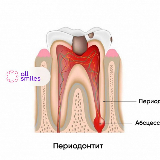 Лечение периодонтита: симптомы, этапы, методы