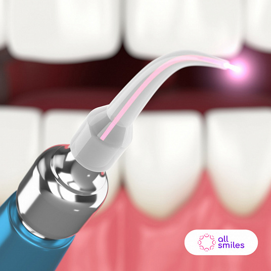 Лечение лазером в стоматологии