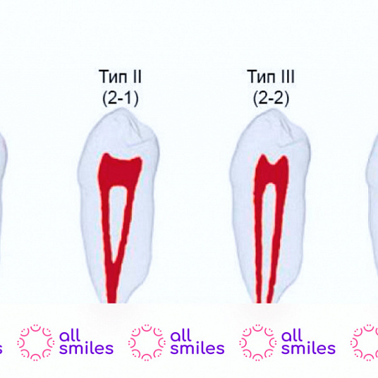 Лечение каналов зуба